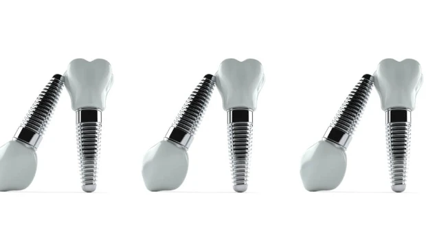 What are the Side Effects of Having Titanium in Your Body